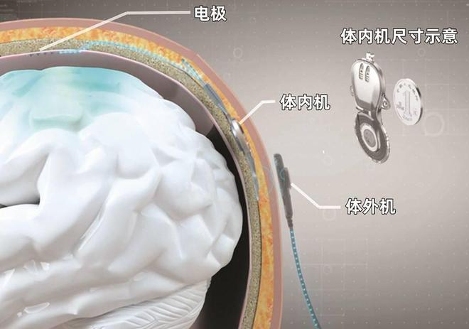 九游娱乐：美国瘫痪男子靠脑机芯片重新动起来！中国也已做到为啥没人关注(图5)